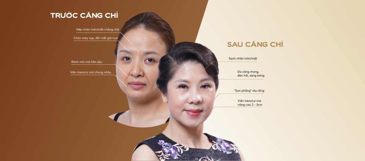 Căng chỉ COLLAGEN GOLD FIBER - Mega Gangnam