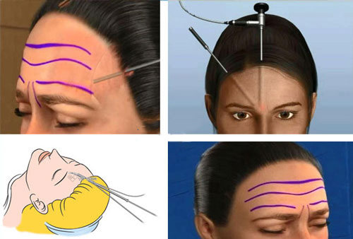 Công nghệ Thermage FLX cũng được nhiều chị em sử dụng