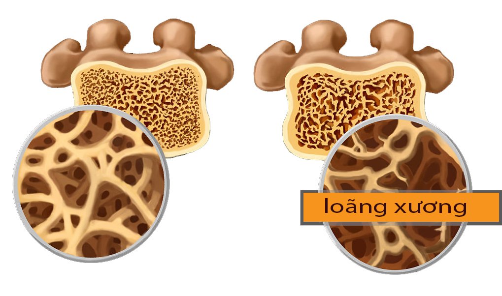 Tác dụng hỗ trợ điều trị loãng xương