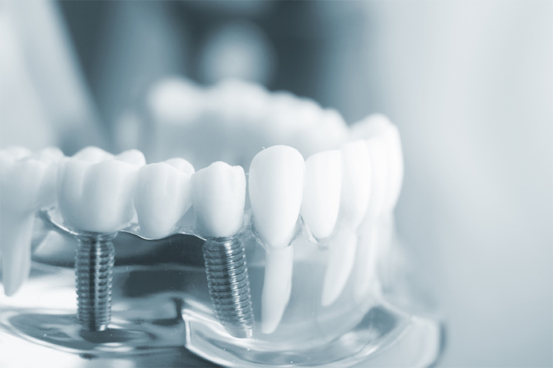 Trồng răng Implant có mắc không? Răng sứ Implant giá bao nhiêu?